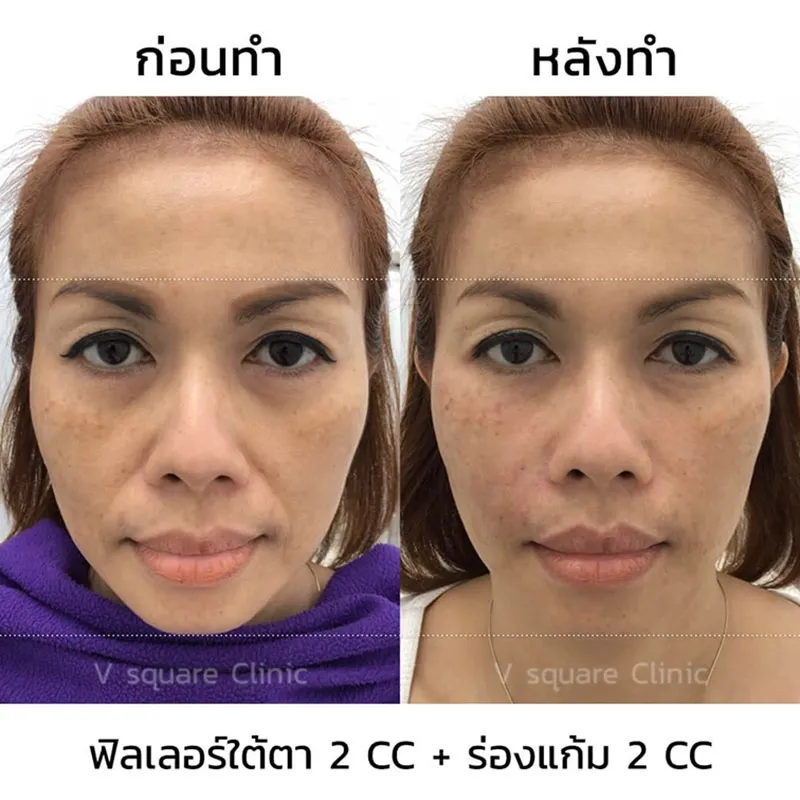 รีวิวฟิลเลอร์ร่องแก้ม 2