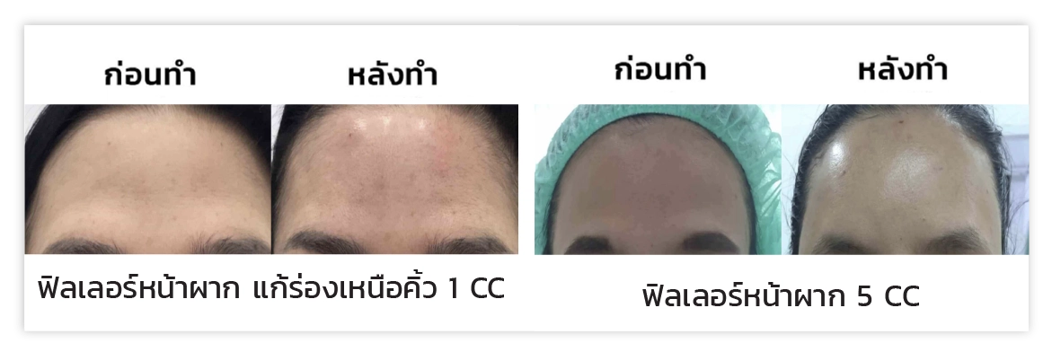 รีวิวฟิลเลอร์หน้าผาก