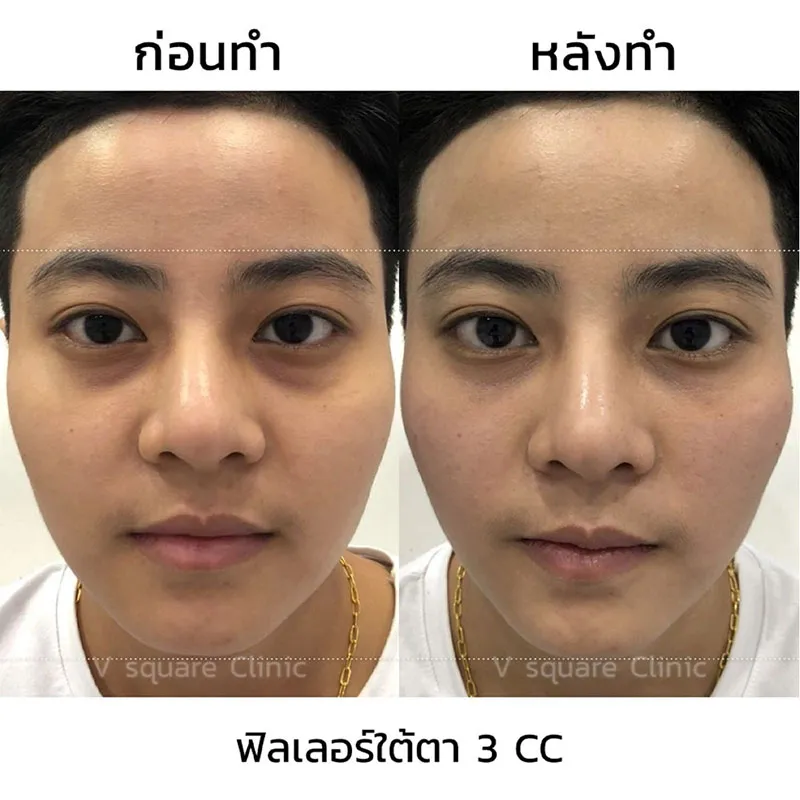 รีวิวฟิลเลอร์ใต้ตา1 