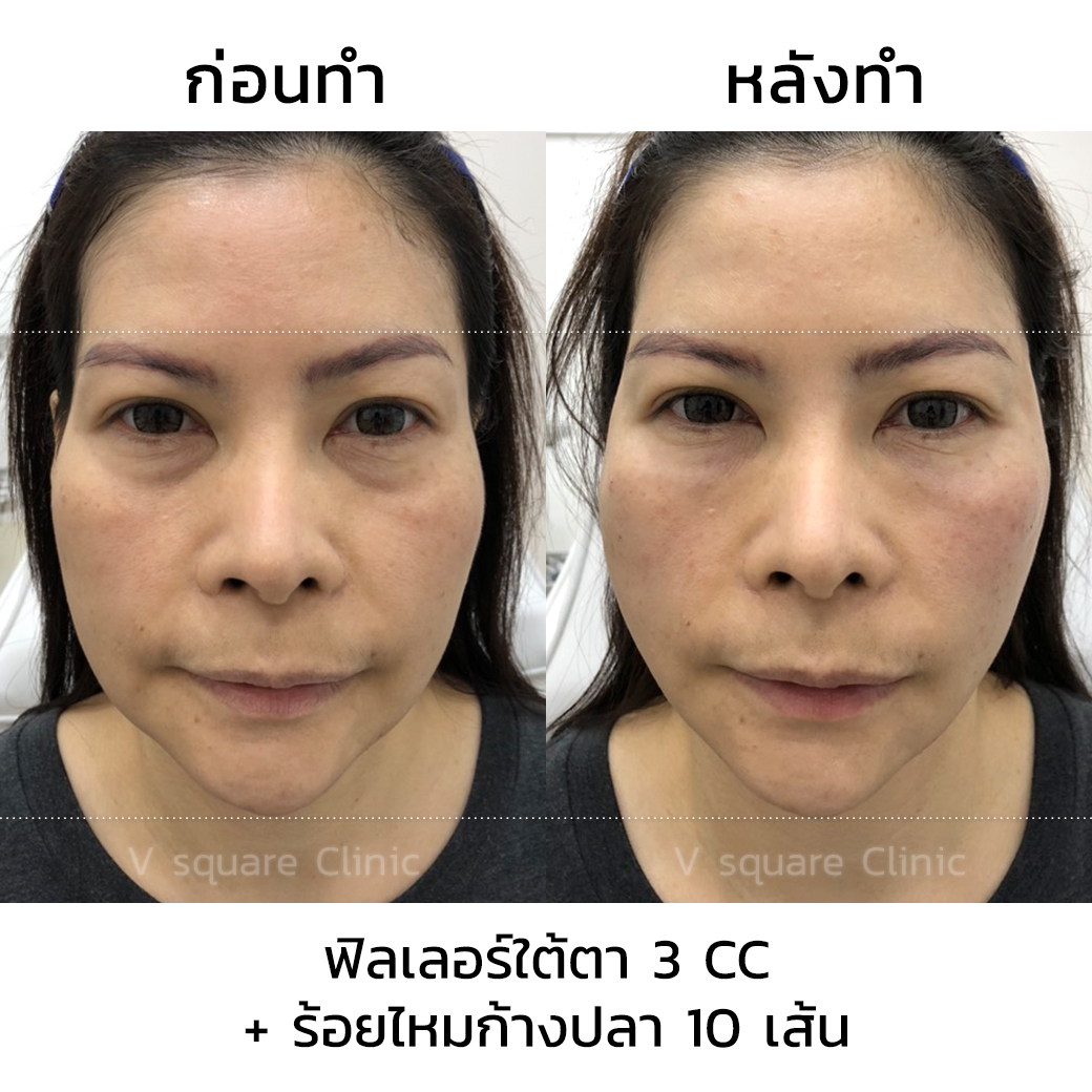 รีวิวร้อยไหมก้างปลา 10 เส้น+ฟิลเลอร์ใต้ตา 3cc