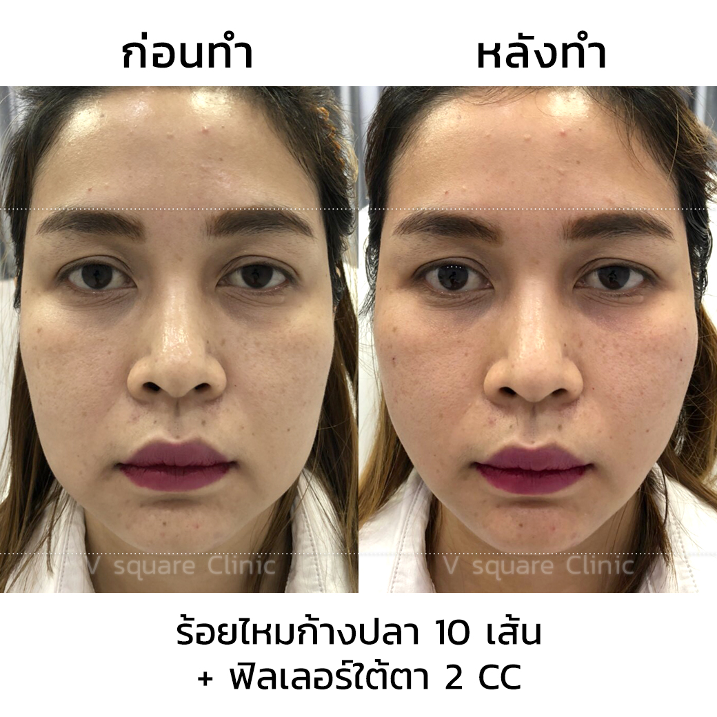 รีวิวร้อยไหมก้างปลา10 เส้น+ฟิลเลอร์ใต้ตา 2 cc