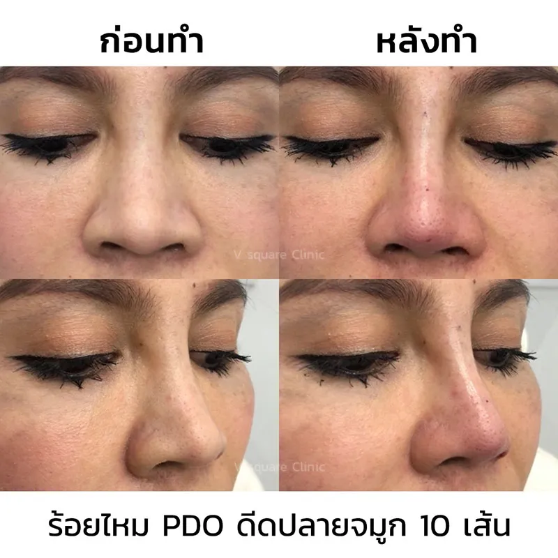 รีวิวร้อยไหมจมูก 10 เส้น_2