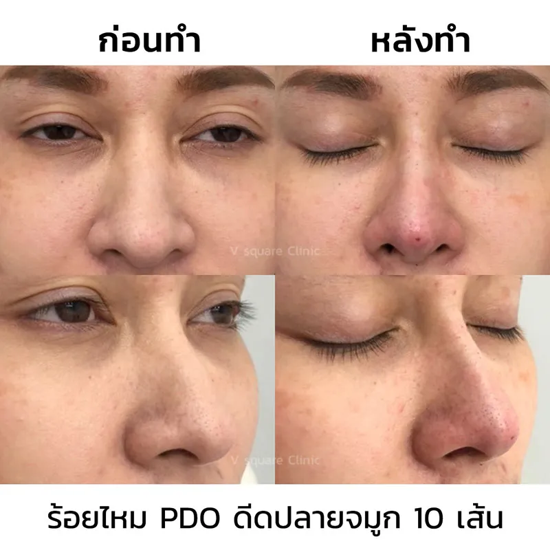 รีวิวร้อยไหมปลายจมูก 10 เส้น_1