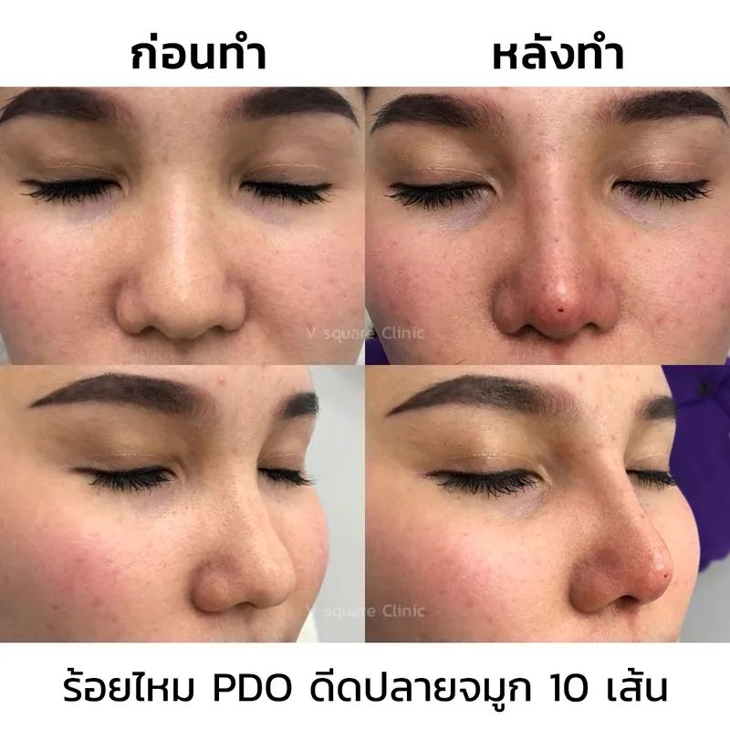 รีวิวร้อยไหมปลายจมูก 10 เส้น_3