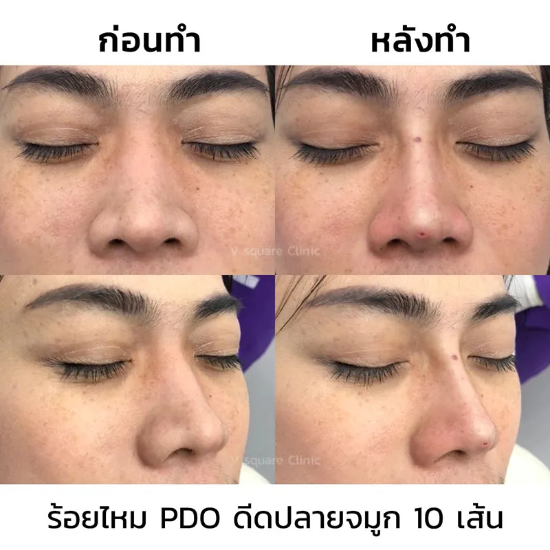 รีวิวร้อยไหมปลายจมูก 10 เส้น_4