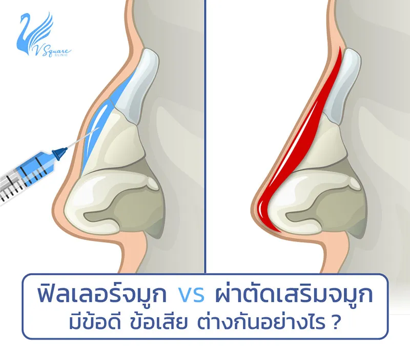 ร้อยไหมจมูก ฟิลเลอร์จมูก