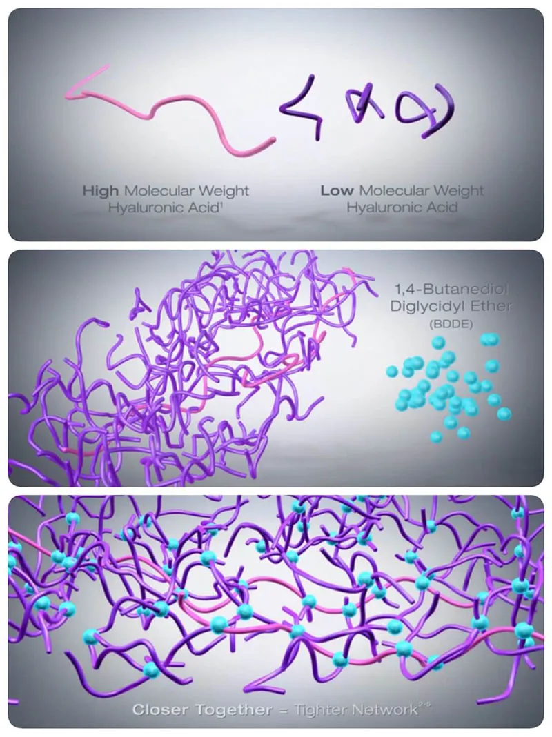 ลักษณะ hyaluronic-acid ฟิลเลอร์