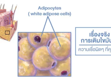 เติมไขมันหน้า