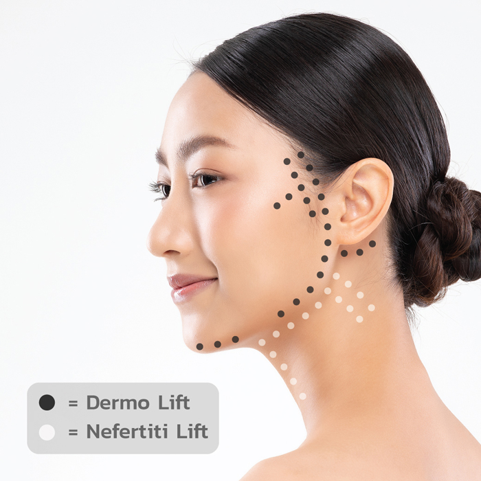 เทคนิคการฉีดโบท็อก dermolift vs nefertiti lift