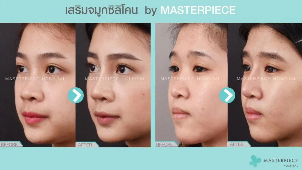 เสริมจมูกที่ไหนดี รู้ 7 ข้อนี้ ก่อนเสริมจมูก เพื่อผลลัพธ์ที่ดีและปลอดภัย เสริมจมูกที่ไหนดี รู้ 7 ข้อนี้ ก่อนเสริมจมูก เพื่อผลลัพธ์ที่ดีและปลอดภัย