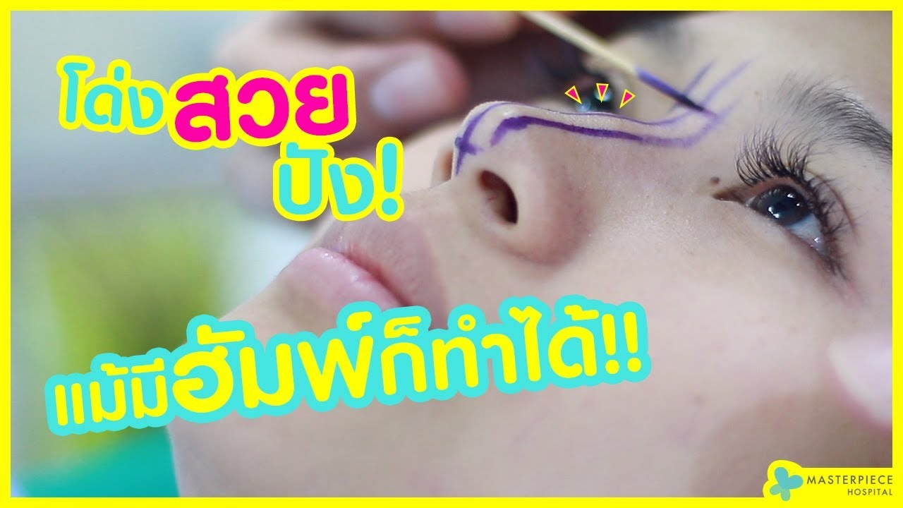 รีวิว เสริมจมูกมีฮัมพ์