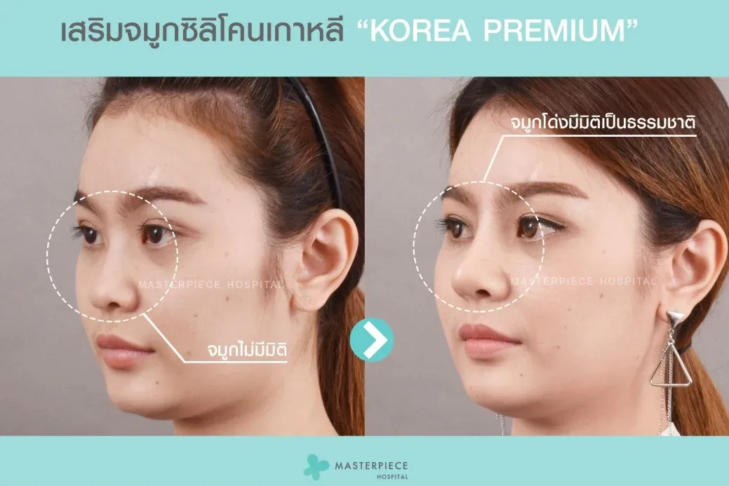 การเสริมจมูกช่วยทำให้ใบหน้าดูมีมิติมากขึ้น