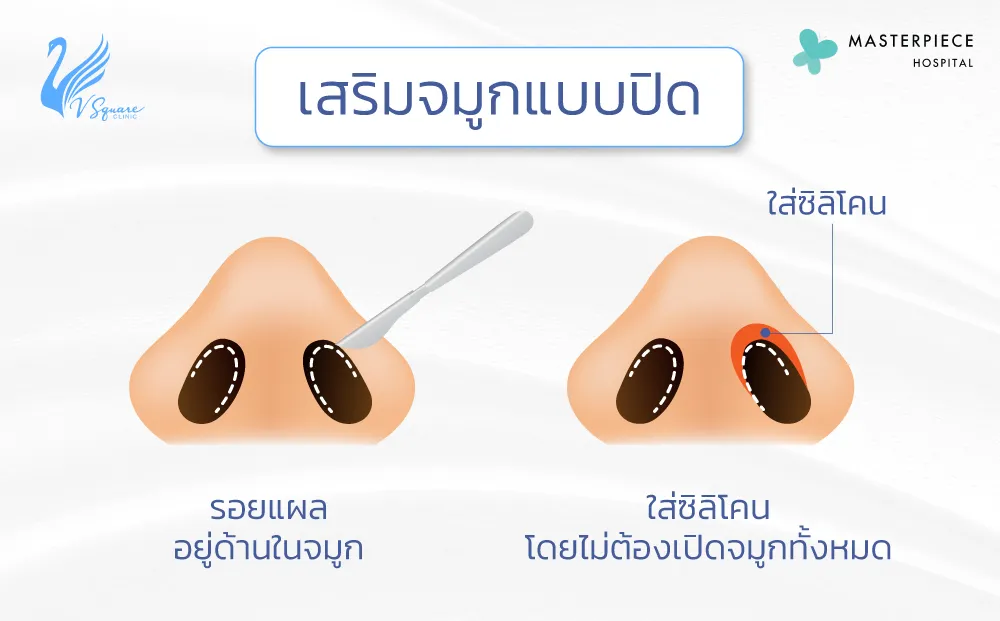 การเสริมจมูกแบบปิด