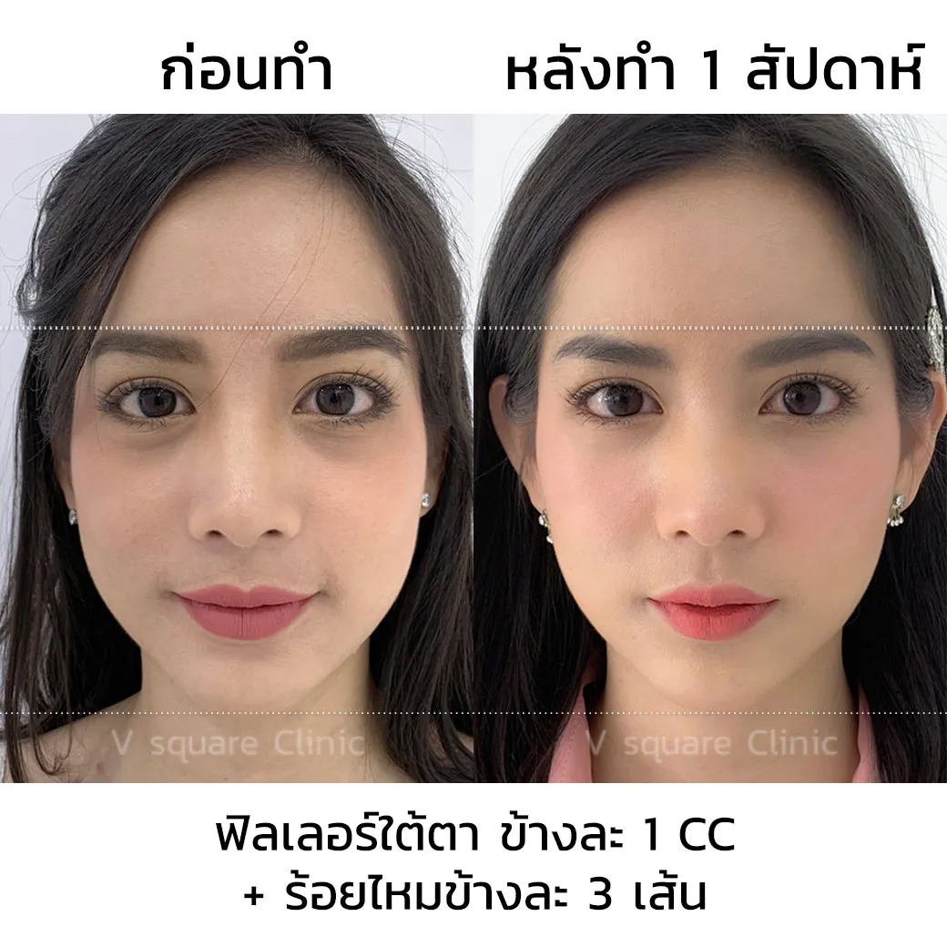 รีวิวหลังฉีดฟิลเลอร์และร้อยไหม 1 สัปดาห์