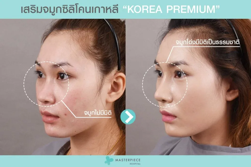 รีวิวเสริมจมูกซิลิโคน3