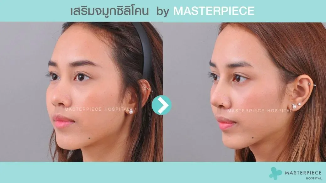 รีวิวเสริมจมูกซิลิโคน4