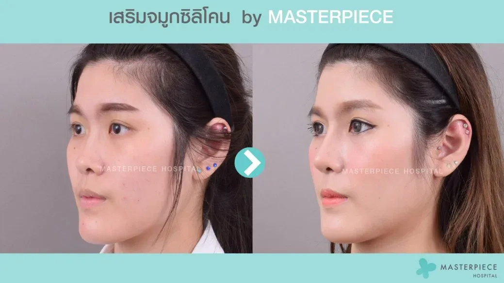 รีวิวเสริมจมูกด้วยซิลิโคน