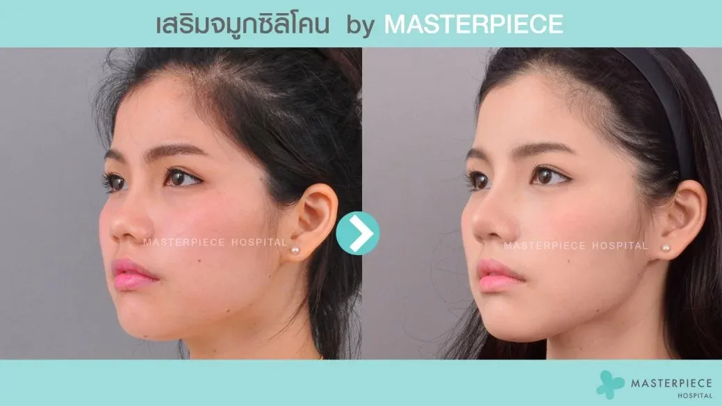 รีวิวเสริมจมูกด้วยซิลิโคน