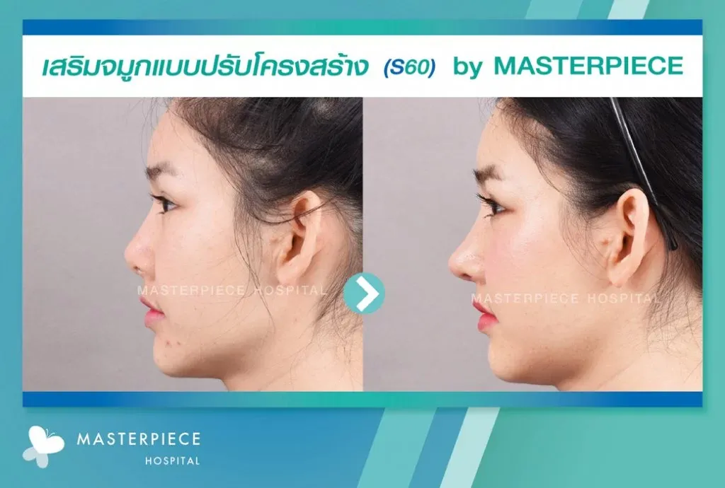 รีวิวเสริมจมูกปรับโครงสร้าง1