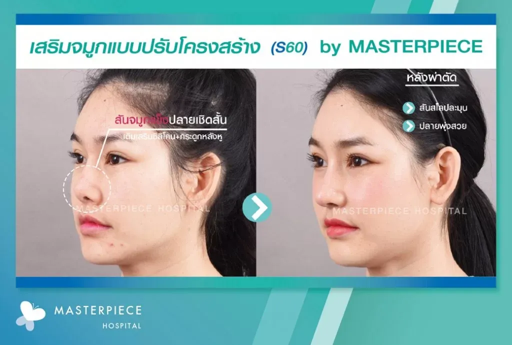 รีวิวเสริมจมูกปรับโครงสร้าง2