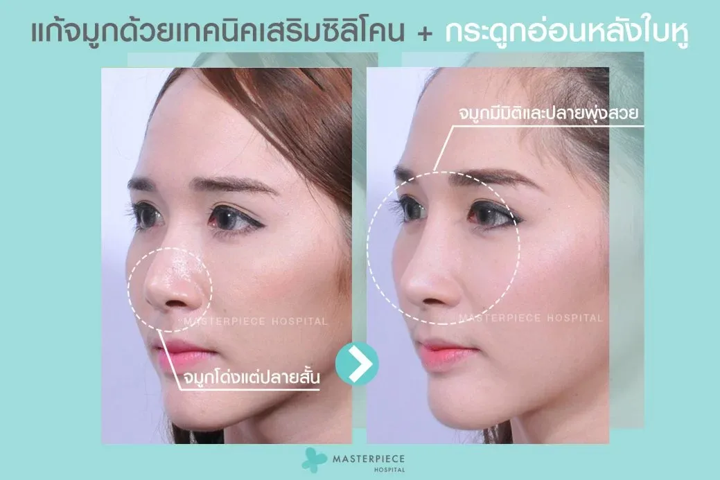 รีวิวเสริมจมูกแบบปิด (กระดูกอ่อนหลังหู)