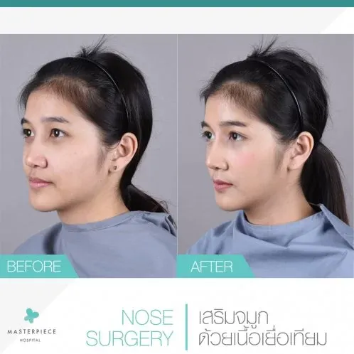 รีวิวเสริมจมูกแบบเปิด เนื้อเยื่อเทียม (NOSE SURGERY)