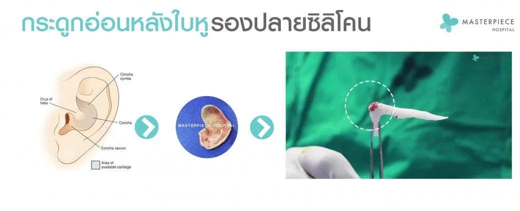 เสริมจมูกกระดูกอ่อนหลังใบหู