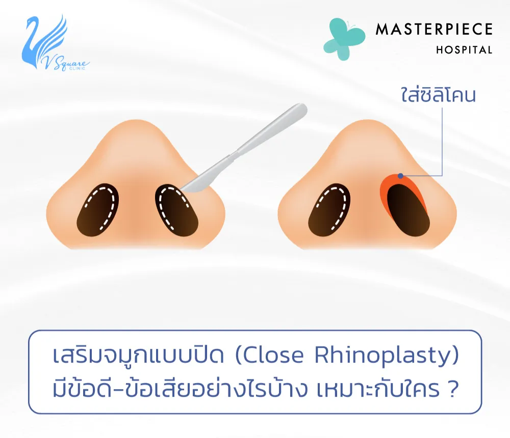 เสริมจมูกแบบปิด1000x860