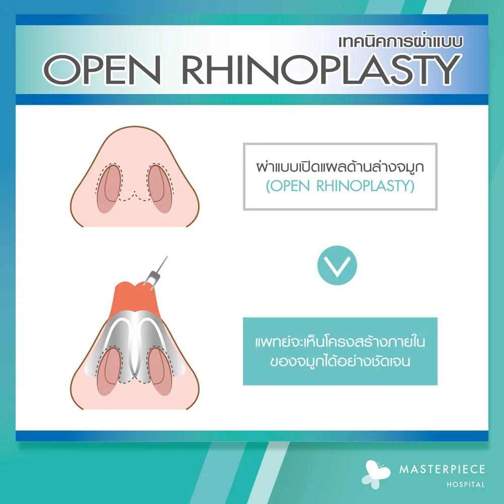 เสริมจมูกแบบโอเพ่น