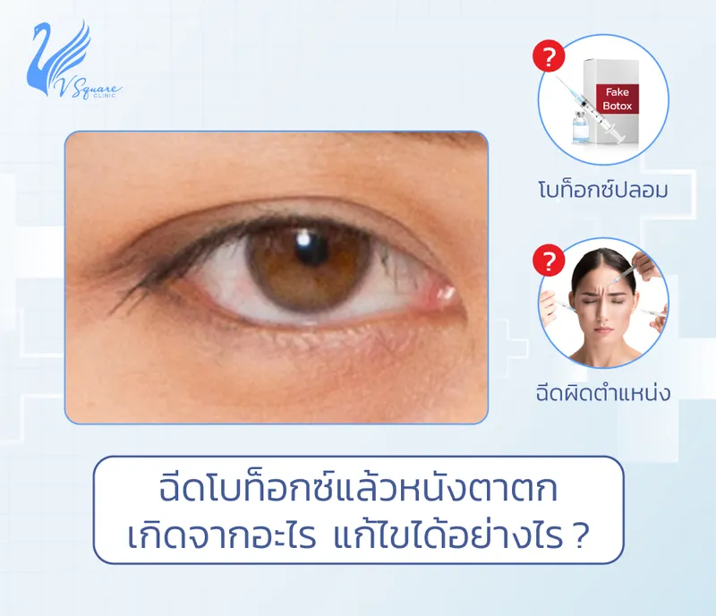 ฉีดโบท็อกหนังตาตก เกิดจากอะไร อันตรายไหม แก้ไขได้อย่างไร