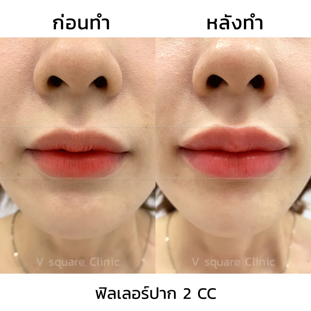 รีวิว ฟิลเลอร์ Restylane Kysse 2CC