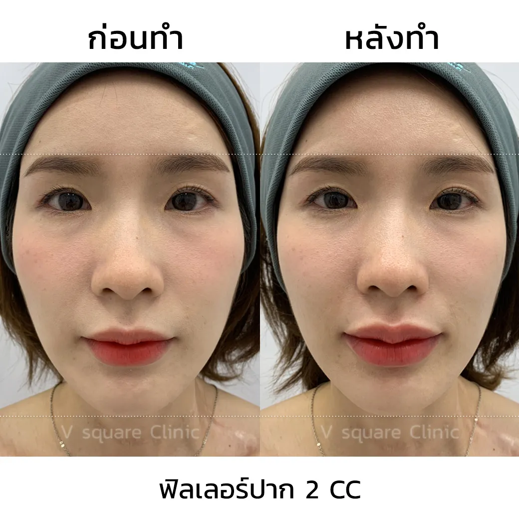 รีวิว ฟิลเลอร์ Restylane Kysse 2CC