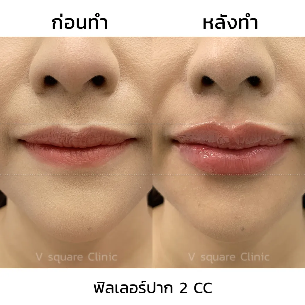 รีวิว ฟิลเลอร์ Restylane Kysse 2CC