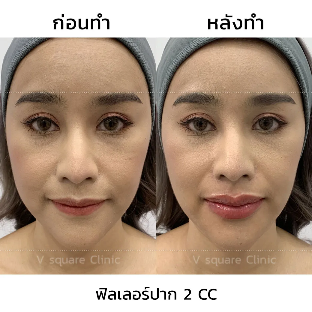 รีวิว ฟิลเลอร์ Restylane Kysse 2CC