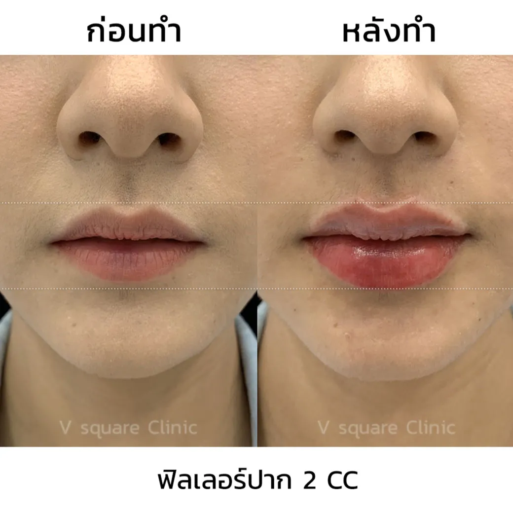 รีวิว ฟิลเลอร์ Restylane Kysse 2CC