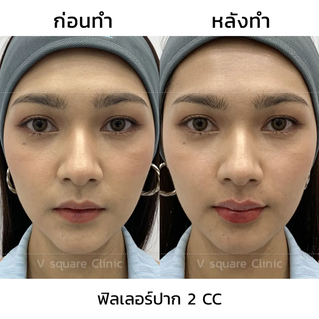 รีวิว ฟิลเลอร์ Restylane Kysse 2CC