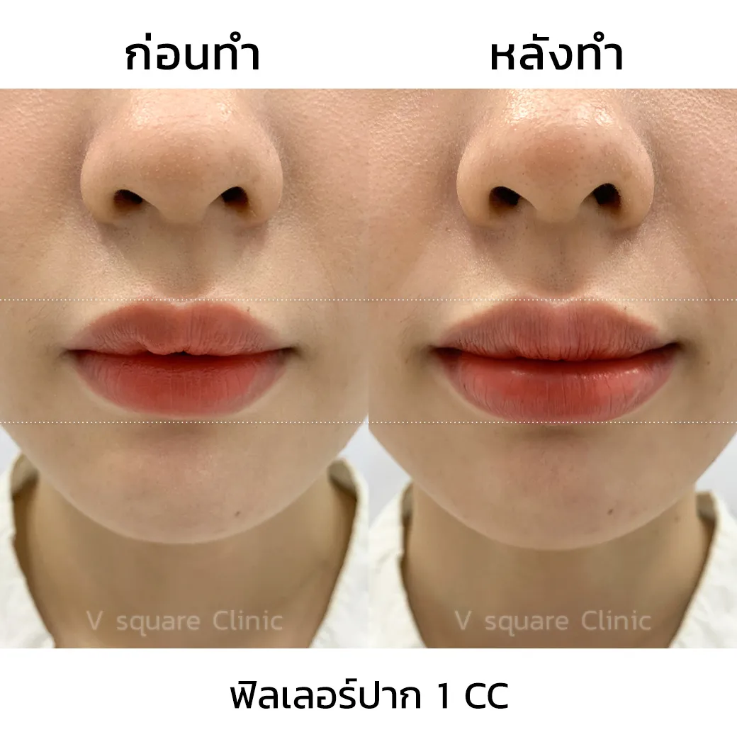 รีวิว ฟิลเลอร์ Restylane Kysse 1CC