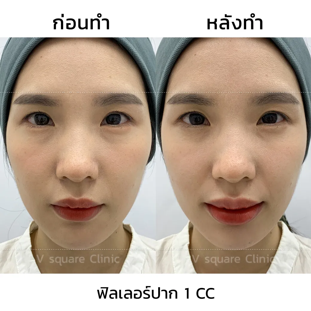 รีวิว ฟิลเลอร์ Restylane Kysse 1CC