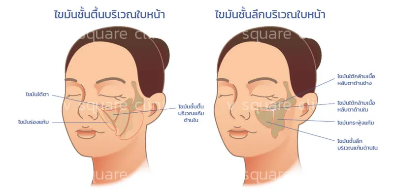 ฉีดเมโสแฟต-สลายไขมันส่วนเกิน