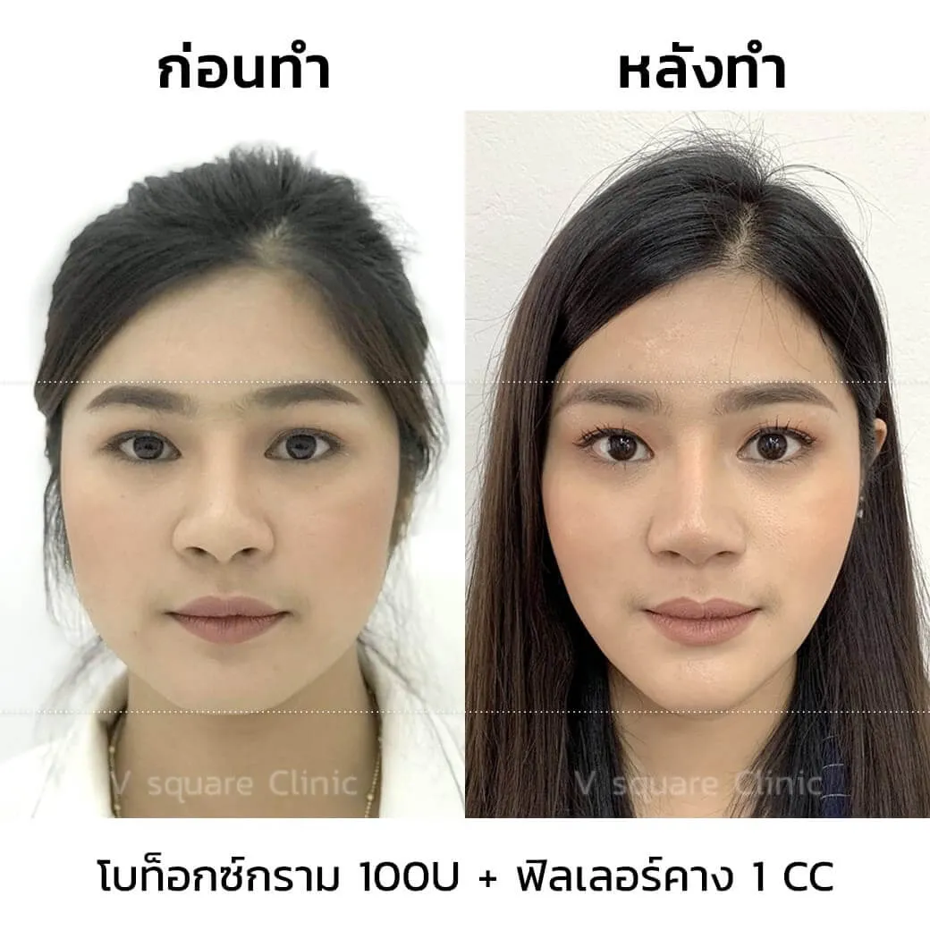 รีวิวฉีด Aestox Botox ลดกราม 100 u + ฟิลเลอร์คาง 1 cc