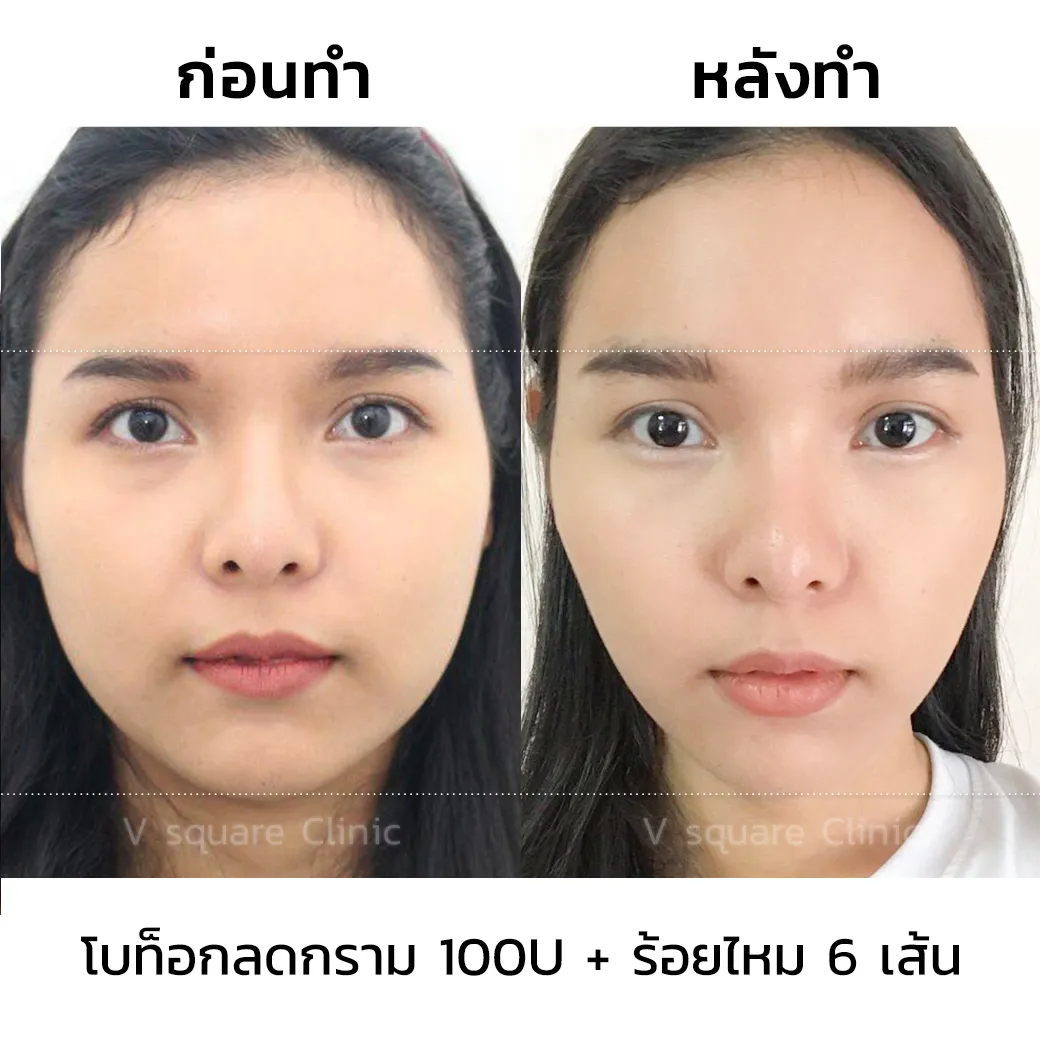 รีวิวฉีด Aestox Botox ลดกราม ปรับหน้าเรียว 100u + ร้อยไหม 6 เส้น