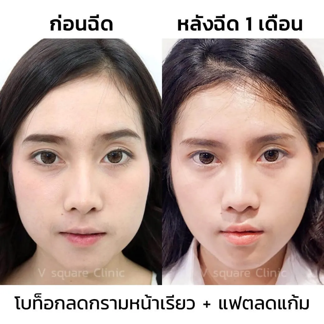 รีวิวฉีด Aestox Botox ลดกราม ปรับหน้าเรียว + แฟตแก้ม