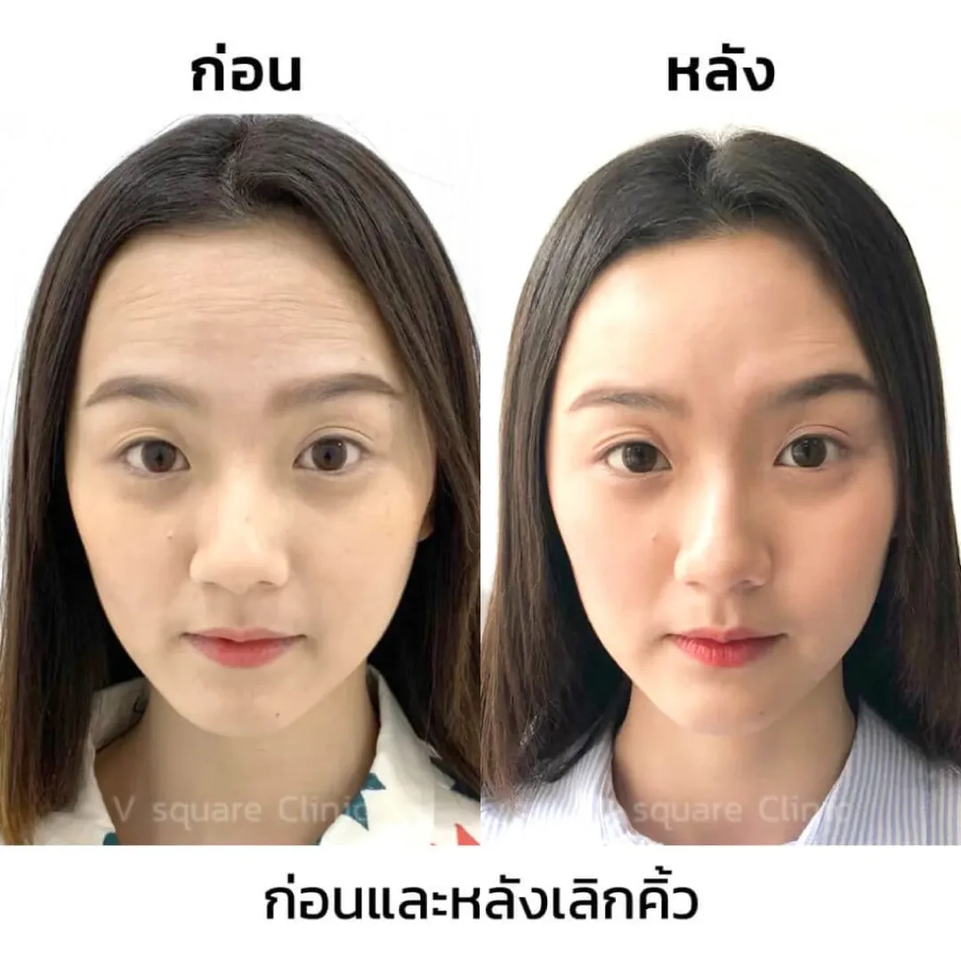 รีวิวโบทอกที่ V square clinic