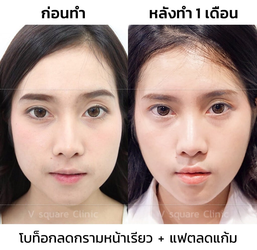 รีวิวโบท็อกลดกราม