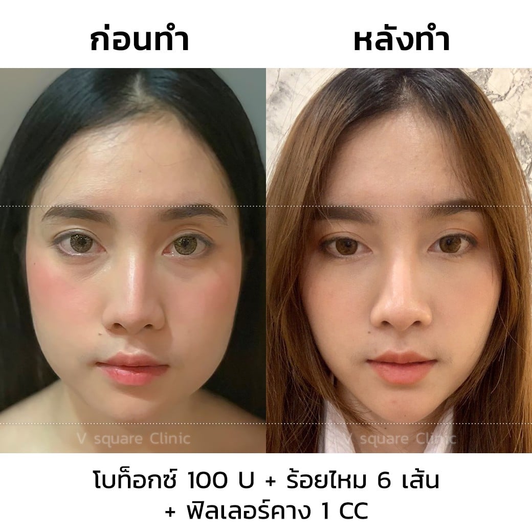 รีวิวโบท็อกหน้าเรียว