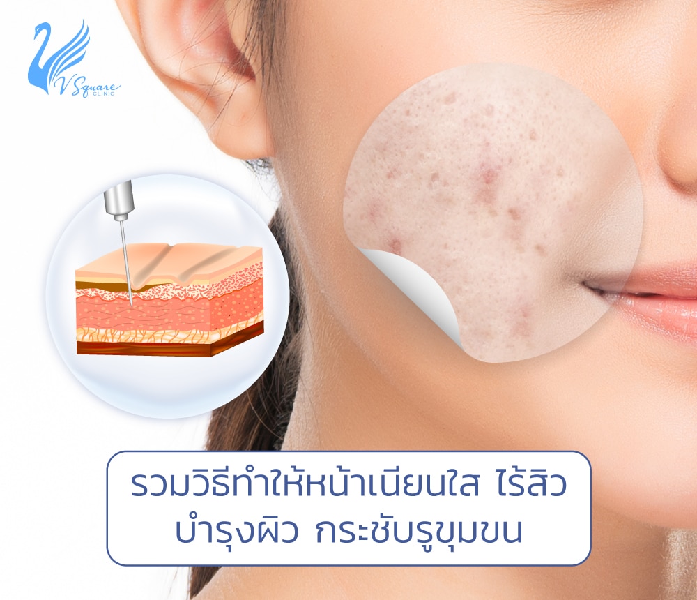 รวมเคล็ดลับวิธีทำให้หน้าใส ไร้สิว เผยผิวกระจ่างใสสุขภาพดี มีวิธีไหนบ้าง ?