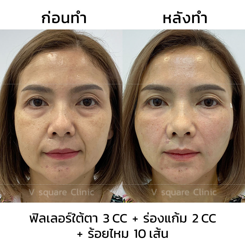 รีวิว ฟิลเลอร์ใต้ตา 3cc+ ร่องแก้ม 2cc+ร้อยไหมก้างปลา 10 เส้น