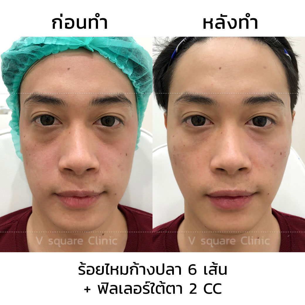 รีวิว ร้อยไหมก้างปลา 6 เส้น+ ฟิลเลอร์ใต้ตา 2 CC