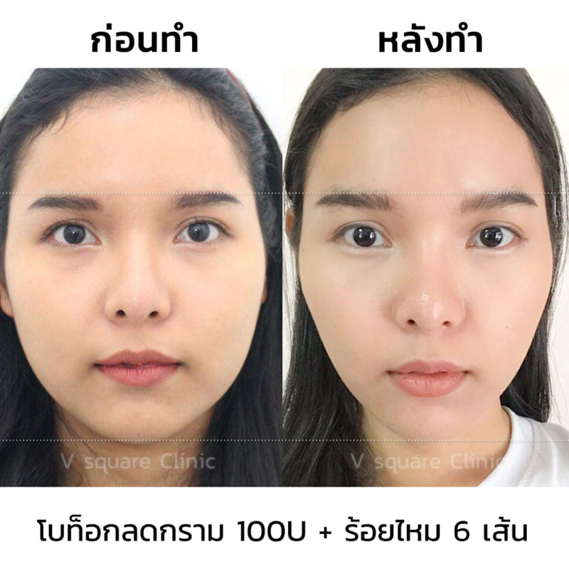 รีวิว ร้อยไหมก้างปลา6 เส้น+ โบท็อกกราม 100U