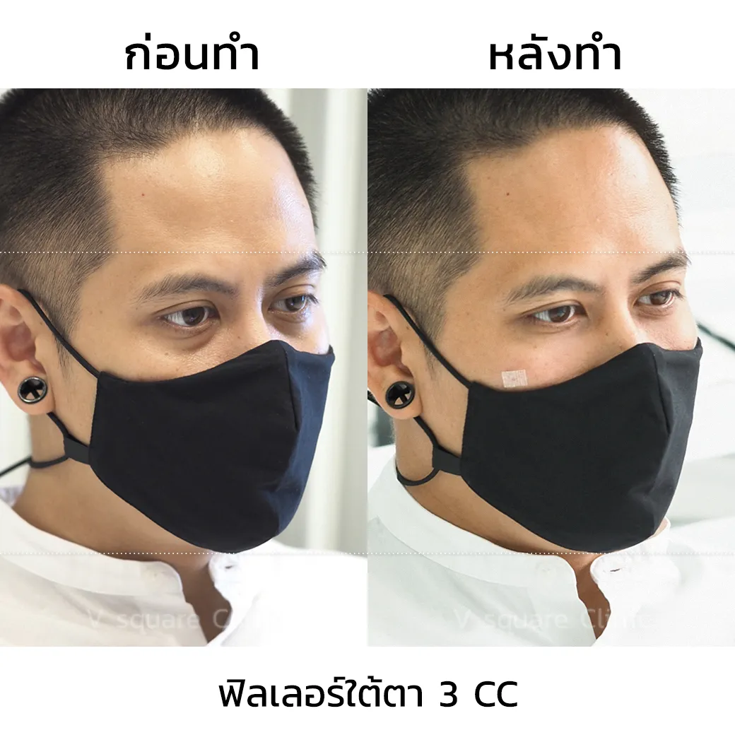 รีวิวฟิลเลอร์ใต้ตา-2-cc-1 คุณไผ่